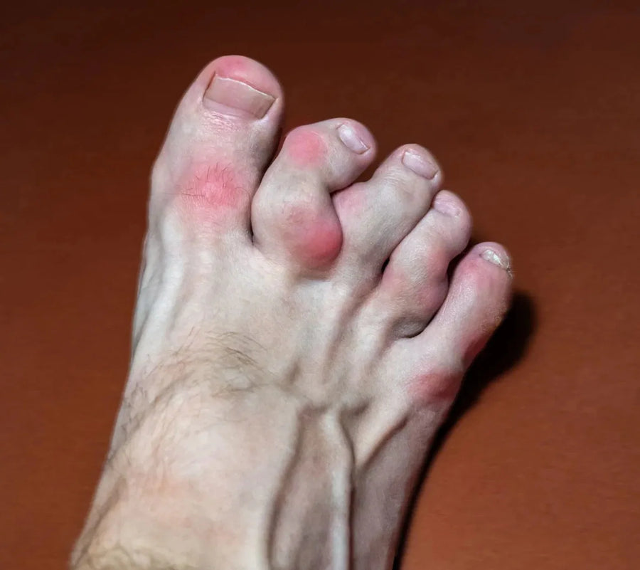 El hallux valgus es progresivo: si no actúas, solo empeora